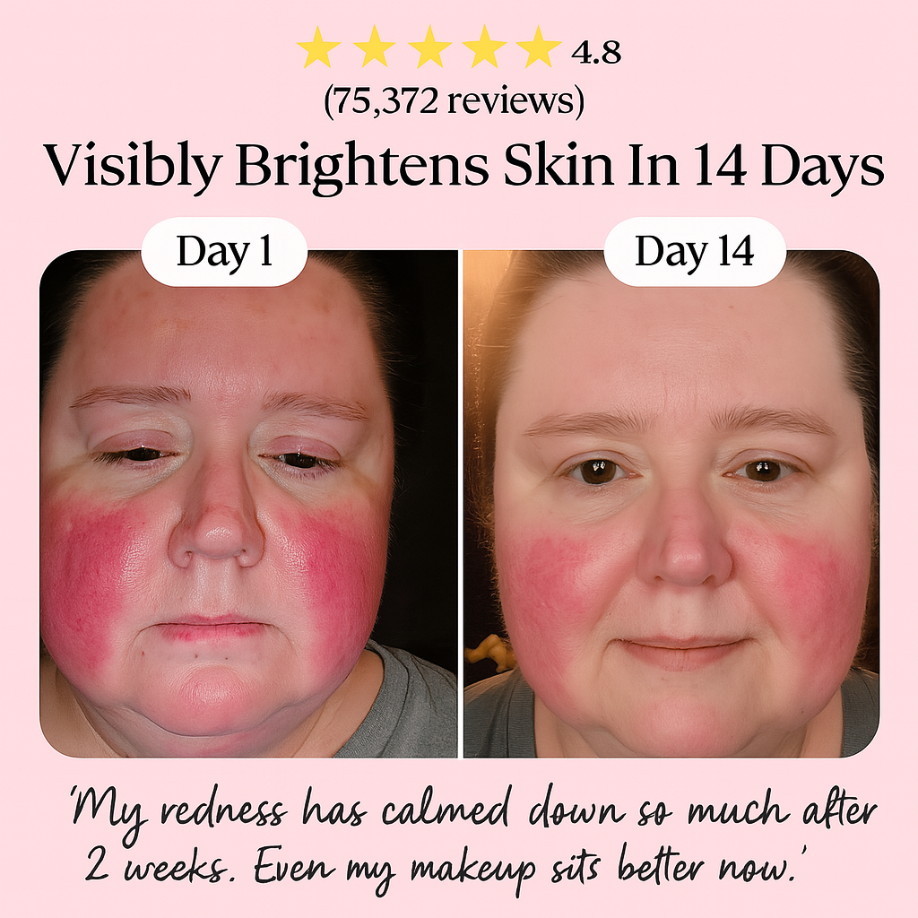 Before and after image showing reduced redness and brighter skin in 14 days using The Korean Skin Co products
